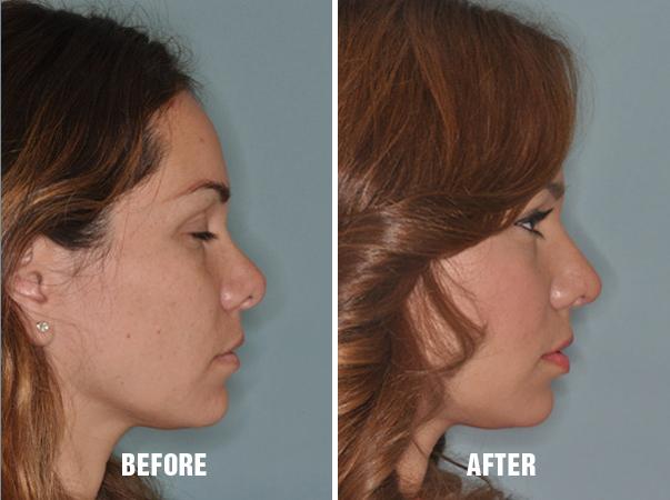 Revision Rhinoplasty Before and After Photos in Miami, FL, Patient 792