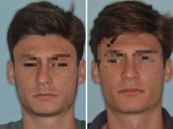 Rhinoplasty Before and After Photos in Miami, FL, Patient 525