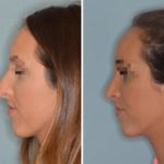 Rhinoplasty Before and After Photos in Miami, FL, Patient 576