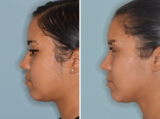 Rhinoplasty Before and After Photos in Miami, FL, Patient 623