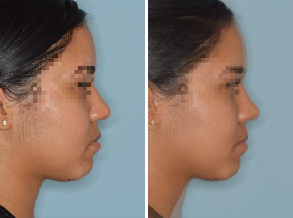 Rhinoplasty Before and After Photos in Miami, FL, Patient 623