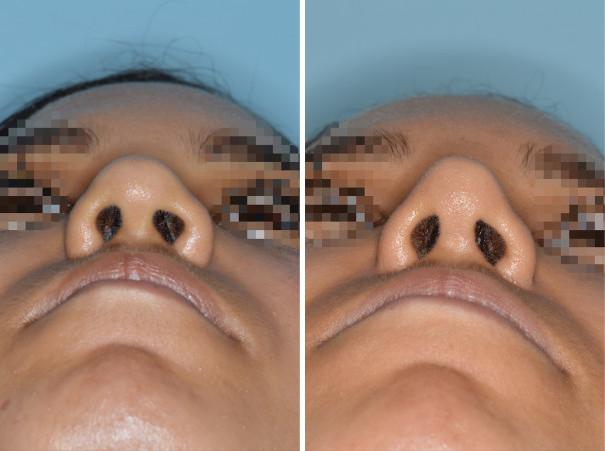 Rhinoplasty Before and After Photos in Miami, FL, Patient 623