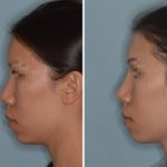 Rhinoplasty Before and After Photos in Miami, FL, Patient 656