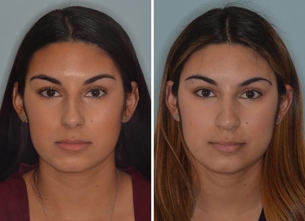 Rhinoplasty Before and After Photos in Miami, FL, Patient 683
