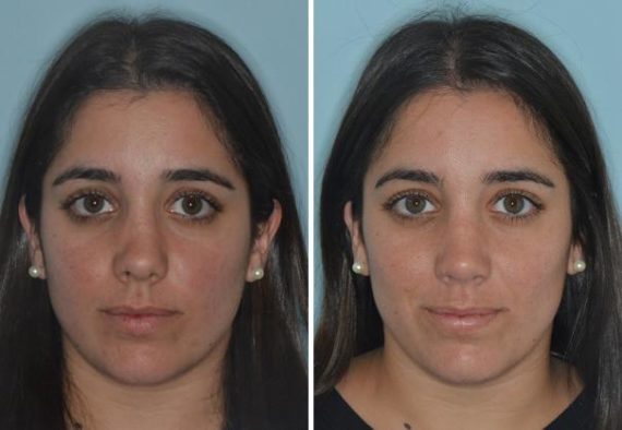 Rhinoplasty Before and After Photos in Miami, FL, Patient 690