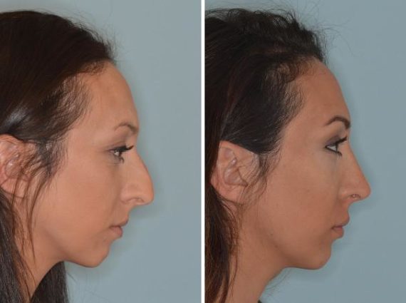 Rhinoplasty Before and After Photos in Miami, FL, Patient 714