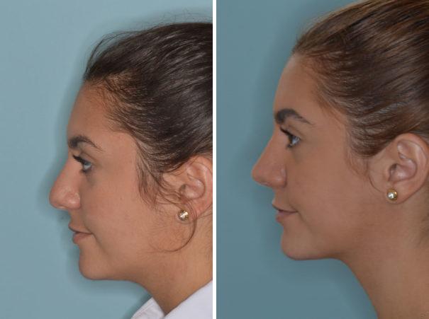 Rhinoplasty Before and After Photos in Miami, FL, Patient 717