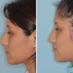 Rhinoplasty Before and After Photos in Miami, FL, Patient 752