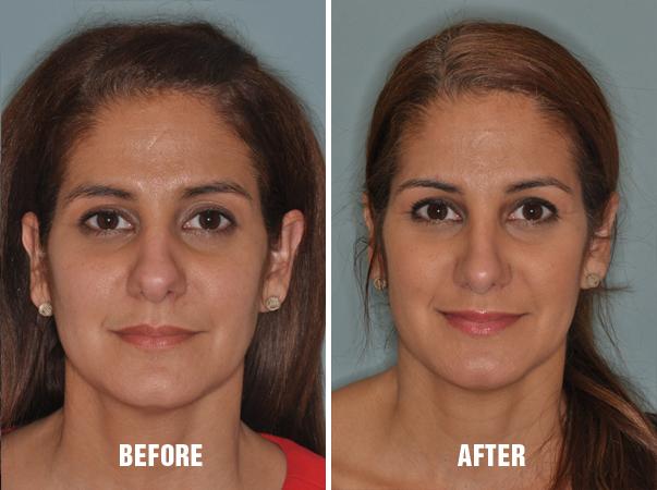 Rhinoplasty Before and After Photos in Miami, FL, Patient 241