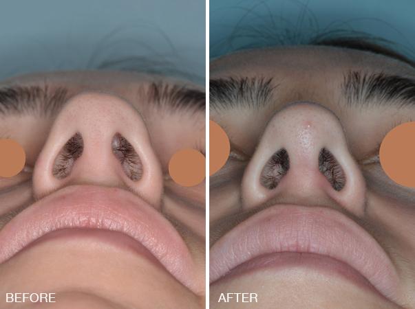 Rhinoplasty Before and After Photos in Miami, FL, Patient 255