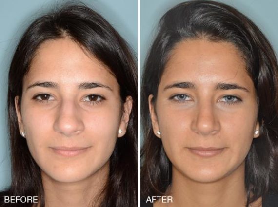 Rhinoplasty Before and After Photos in Miami, FL, Patient 278