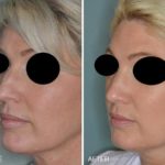 Rhinoplasty Before and After Photos in Miami, FL, Patient 328