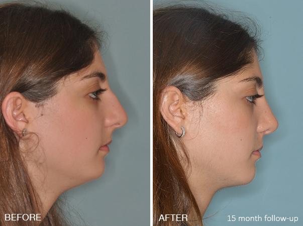 Rhinoplasty Before and After Photos in Miami, FL, Patient 191