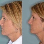 Rhinoplasty Before and After Photos in Miami, FL, Patient 380