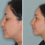 Rhinoplasty Before and After Photos in Miami, FL, Patient 421