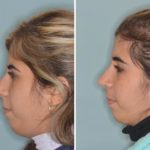Rhinoplasty Before and After Photos in Miami, FL, Patient 439
