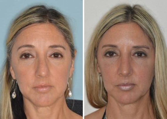 Rhinoplasty Before and After Photos in Miami, FL, Patient 444