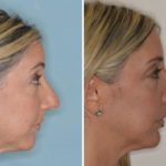 Rhinoplasty Before and After Photos in Miami, FL, Patient 444