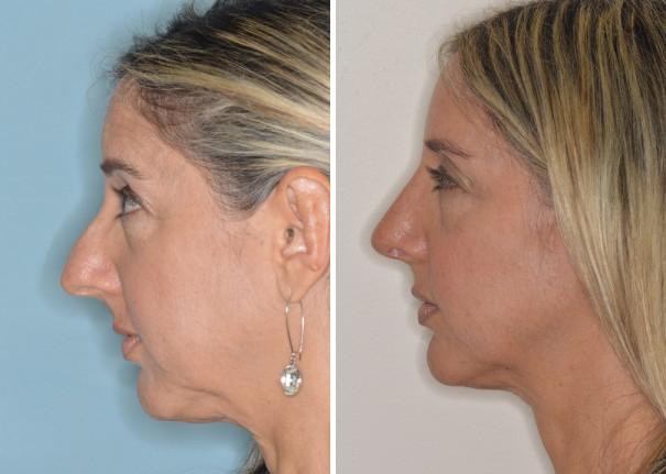 Rhinoplasty Before and After Photos in Miami, FL, Patient 444