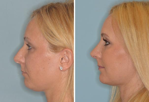 Rhinoplasty Before and After Photos in Miami, FL, Patient 460