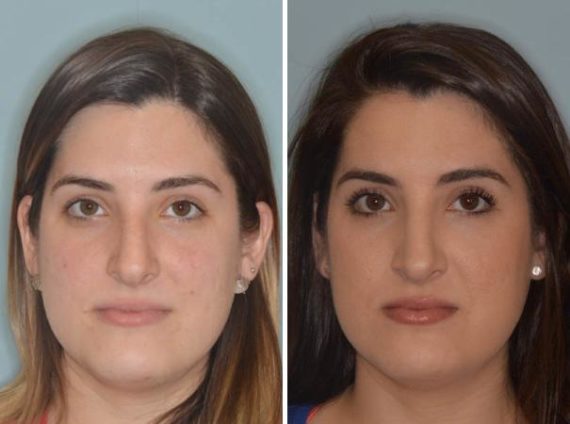 Rhinoplasty Before and After Photos in Miami, FL, Patient 477