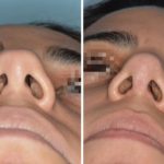 Rhinoplasty Before and After Photos in Miami, FL, Patient 492
