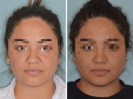 Rhinoplasty Before and After Photos in Miami, FL, Patient 505