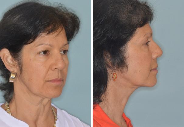 Facelift Before and After Photos in Miami, FL, Patient 2618