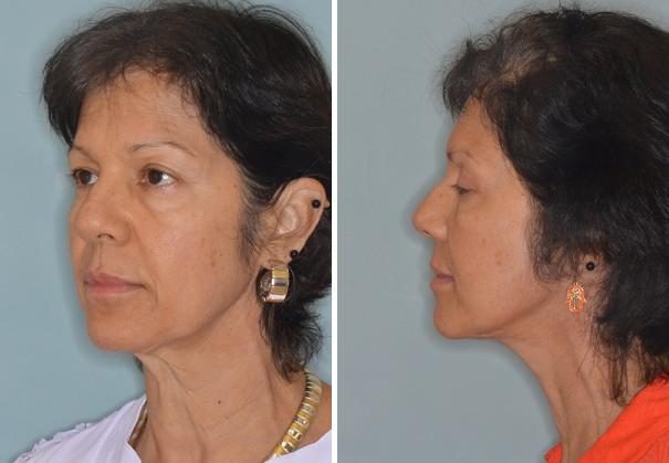 Facelift Before and After Photos in Miami, FL, Patient 2618