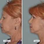 Facelift Before and After Photos in Miami, FL, Patient 2540