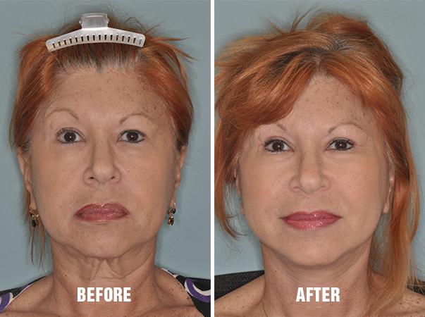 Facelift Before and After Photos in Miami, FL, Patient 2540
