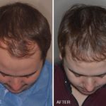 Hair Transplant Before and After Photos in Miami, FL, Patient 2690