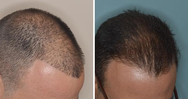 Hair Transplant Photos | Miami, FL | Patient 2698