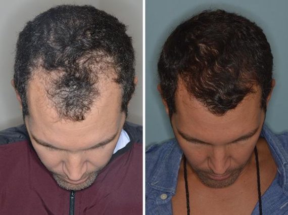 Hair Transplant Before and After Photos in Miami, FL, Patient 2701