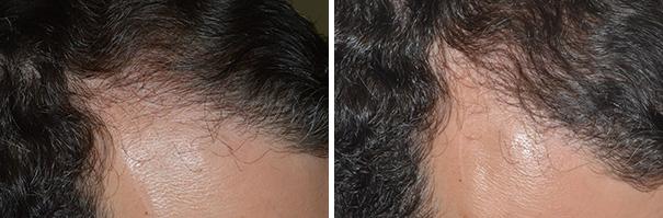 Hair Transplant Before and After Photos in Miami, FL, Patient 2701