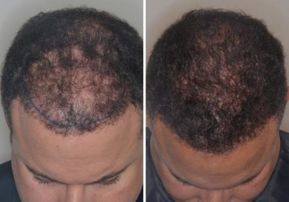 Hair Transplant Before and After Photos in Miami, FL, Patient 2743