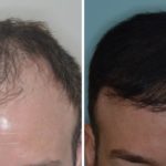 Hair Transplant Before and After Photos in Miami, FL, Patient 2754