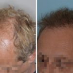 Hair Transplant Before and After Photos in Miami, FL, Patient 2760