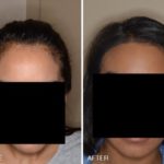 Hair Transplant Before and After Photos in Miami, FL, Patient 2684