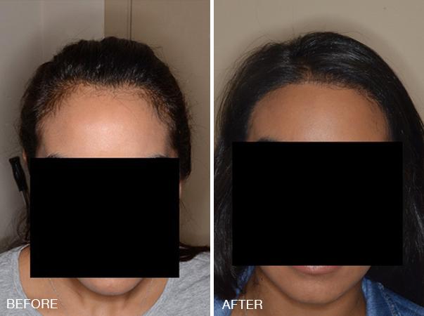 Hair Transplant Before and After Photos in Miami, FL, Patient 2684