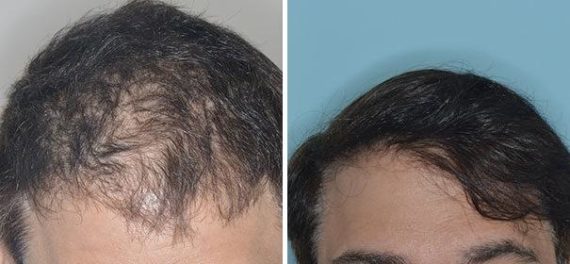 Hair Transplant Before and After Photos in Miami, FL, Patient 2766