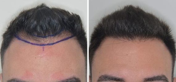 Hair Transplant Before and After Photos in Miami, FL, Patient 2769