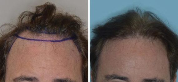 Hair Transplant Before and After Photos in Miami, FL, Patient 2773