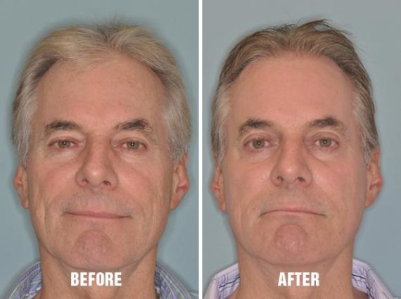 Laser Resurfacing Before and After Photos in Miami, FL, Patient 2632