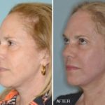 Laser Resurfacing Before and After Photos in Miami, FL, Patient 2564