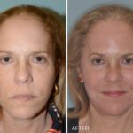 Necklift Before and After Photos in Miami, FL, Patient 2563