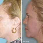 Necklift Before and After Photos in Miami, FL, Patient 2563