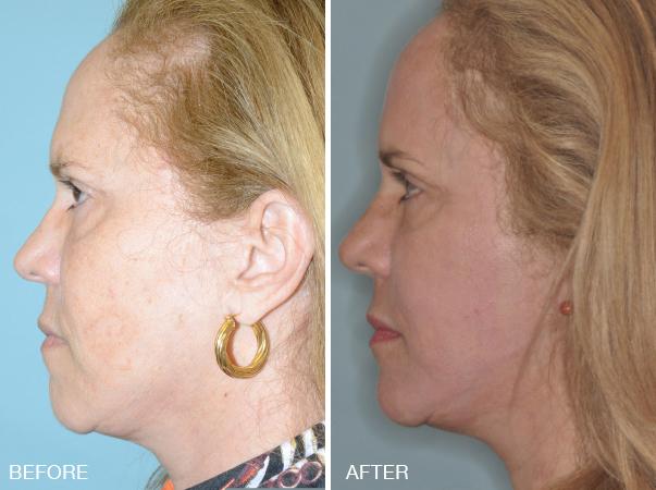 Necklift Before and After Photos in Miami, FL, Patient 2563