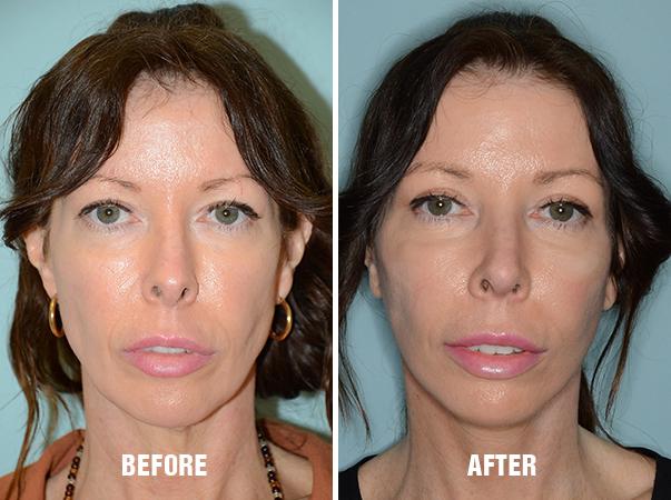 Necklift Before and After Photos in Miami, FL, Patient 2588