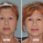 Necklift Before and After Photos in Miami, FL, Patient 2534